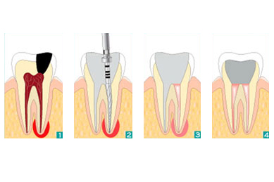 Endodontie Waarschoot Lovendegem Zomergem Eeklo Sleidinge Beke Meetjesland