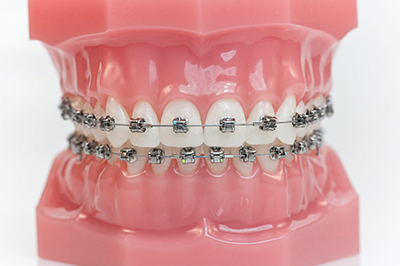 Orthodontie Waarschoot Lovendegem Zomergem Eeklo Sleidinge Beke Meetjesland